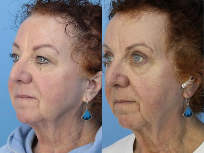 Before & After Blepharoplasty (Upper Eyelid Lift) Case 447 Left Oblique View in West Des Moines & Ames, IA