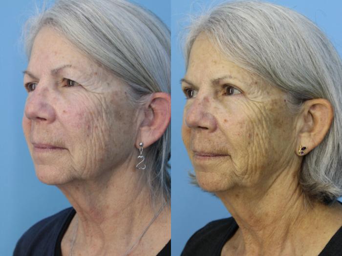 Before & After Blepharoplasty (Upper Eyelid Lift) Case 448 Left Oblique View in West Des Moines & Ames, IA