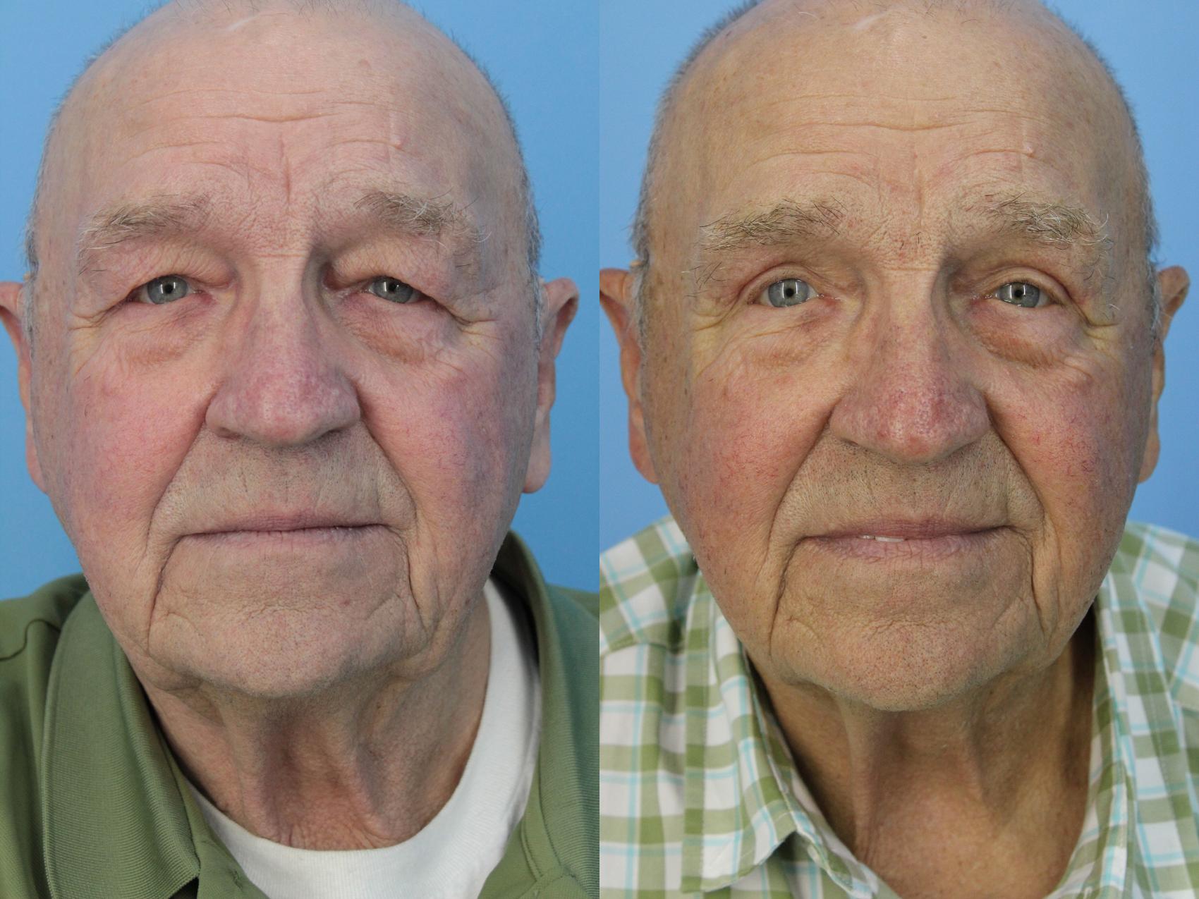 Before & After Blepharoplasty (Upper Eyelid Lift) Case 454 Front View in West Des Moines & Ames, IA