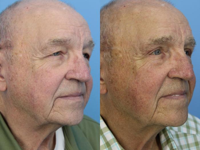 Before & After Blepharoplasty (Upper Eyelid Lift) Case 454 Right Oblique View in West Des Moines & Ames, IA