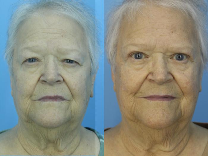 Before & After Blepharoplasty (Upper Eyelid Lift) Case 467 Front View in West Des Moines & Ames, IA