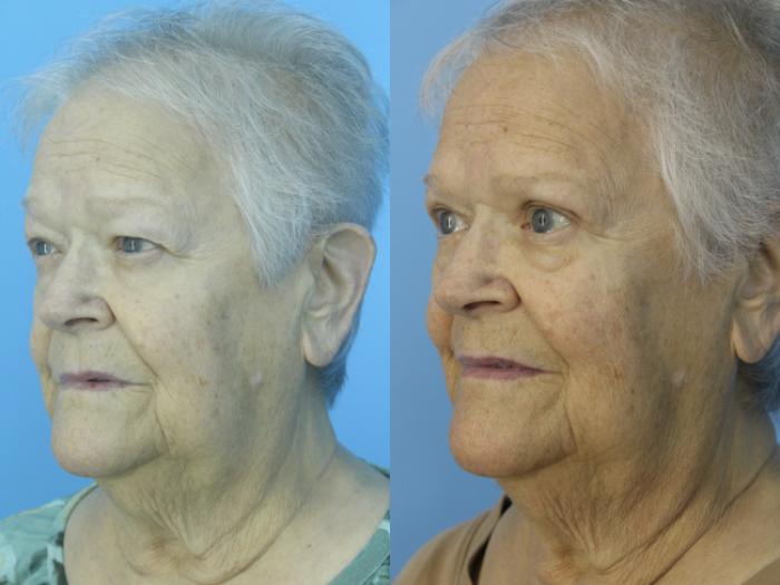 Before & After Blepharoplasty (Upper Eyelid Lift) Case 467 Left Oblique View in West Des Moines & Ames, IA