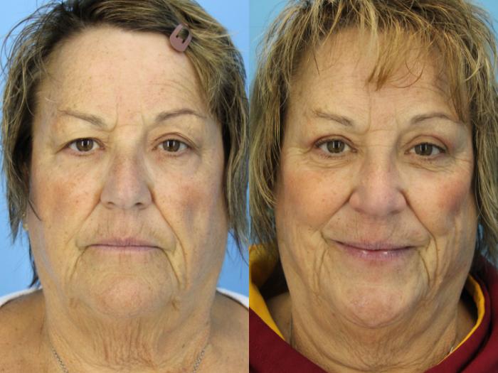 Before & After Blepharoplasty (Upper Eyelid Lift) Case 493 Front View in West Des Moines & Ames, IA