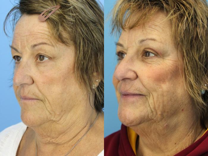 Before & After Blepharoplasty (Upper Eyelid Lift) Case 493 Left Oblique View in West Des Moines & Ames, IA