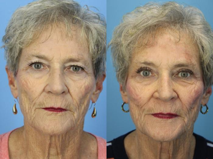 Before & After Blepharoplasty (Upper Eyelid Lift) Case 502 Front View in West Des Moines & Ames, IA