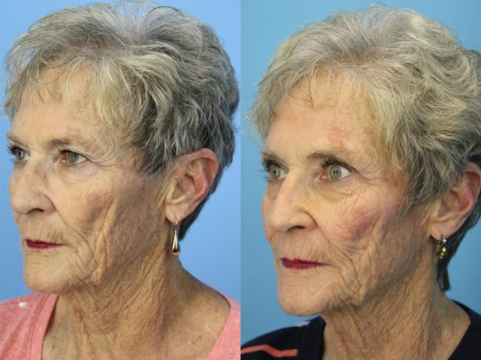 Before & After Blepharoplasty (Upper Eyelid Lift) Case 502 Left Oblique View in West Des Moines & Ames, IA