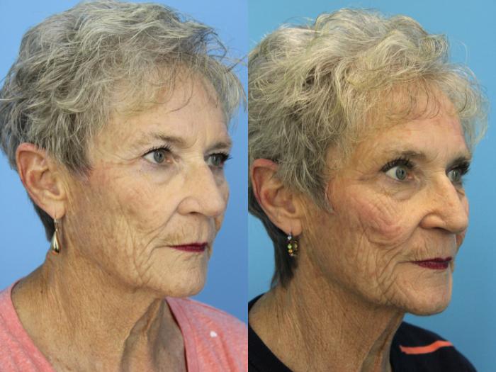 Before & After Blepharoplasty (Upper Eyelid Lift) Case 502 Right Oblique View in West Des Moines & Ames, IA