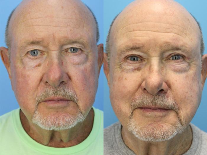 Before & After Blepharoplasty (Upper Eyelid Lift) Case 503 Front View in West Des Moines & Ames, IA