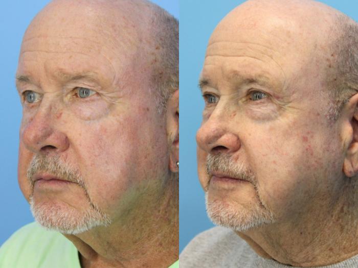 Before & After Blepharoplasty (Upper Eyelid Lift) Case 503 Left Oblique View in West Des Moines & Ames, IA