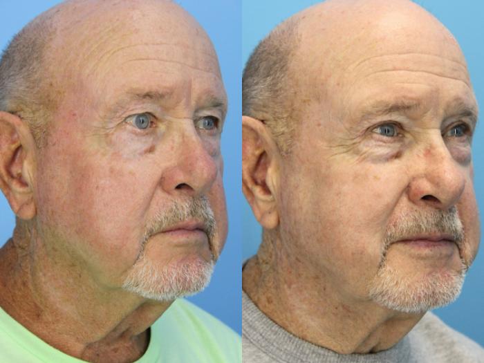 Before & After Blepharoplasty (Upper Eyelid Lift) Case 503 Right Oblique View in West Des Moines & Ames, IA