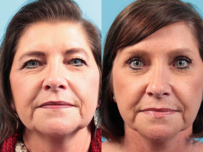 Before & After Blepharoplasty (Upper Eyelid Lift) Case 63 View #1 View in West Des Moines & Ames, IA