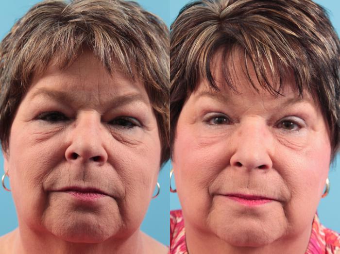 Before & After Blepharoplasty (Upper Eyelid Lift) Case 66 View #1 View in West Des Moines & Ames, IA