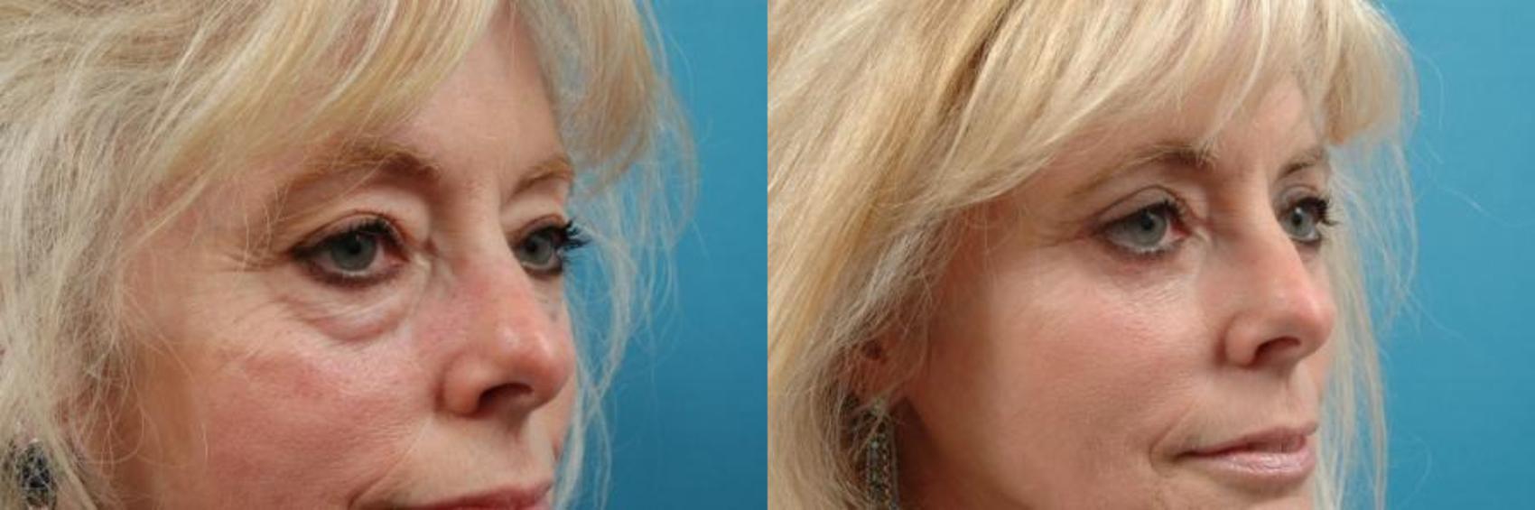 Before & After Blepharoplasty (Upper Eyelid Lift) Case 7 View #1 View in West Des Moines & Ames, IA