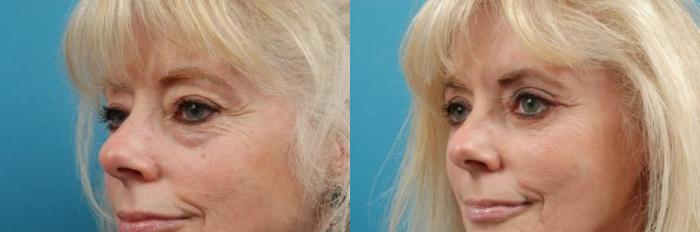 Before & After Blepharoplasty (Lower, Under Eyes) Case 7 View #2 View in West Des Moines & Ames, IA