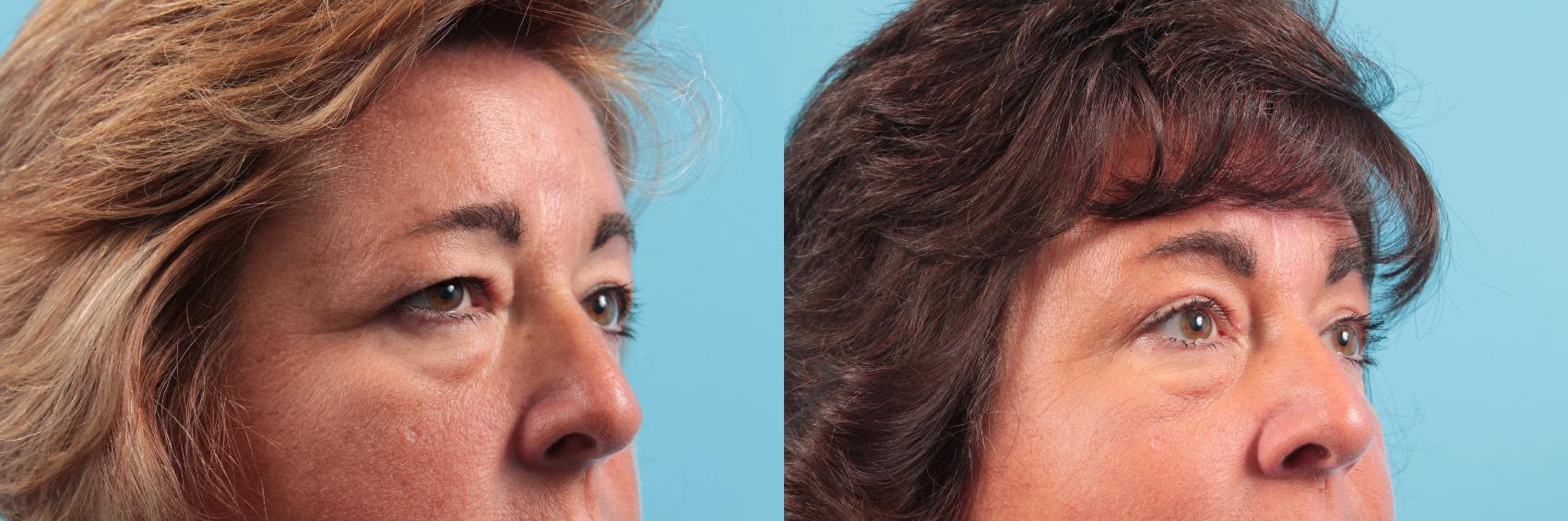 Before & After Brow Lift Case 71 View #1 View in West Des Moines & Ames, IA