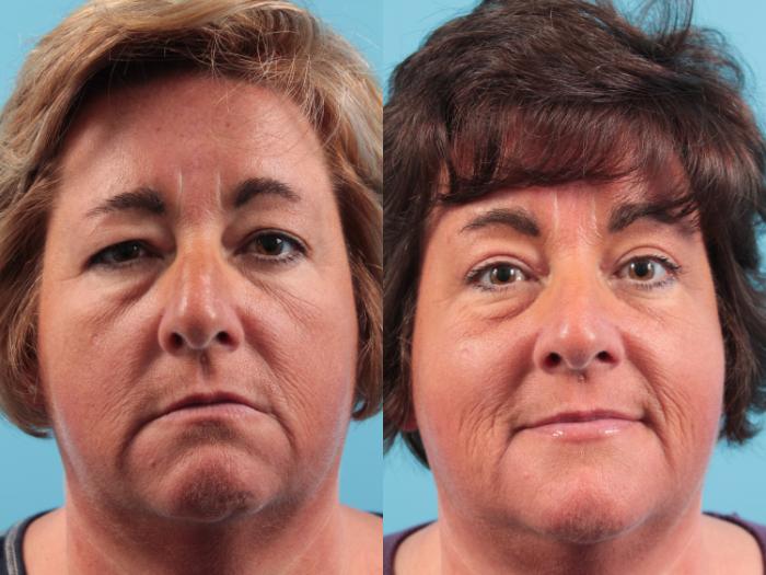 Before & After Blepharoplasty (Upper Eyelid Lift) Case 71 View #2 View in West Des Moines & Ames, IA