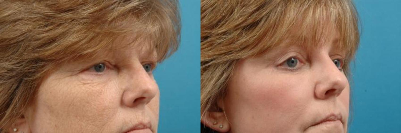Before & After Blepharoplasty (Upper Eyelid Lift) Case 9 View #1 View in West Des Moines & Ames, IA