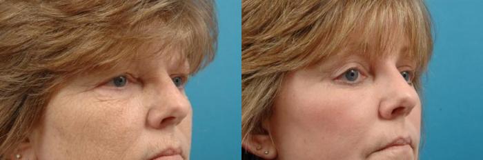 Before & After Blepharoplasty (Lower, Under Eyes) Case 9 View #1 View in West Des Moines, IA