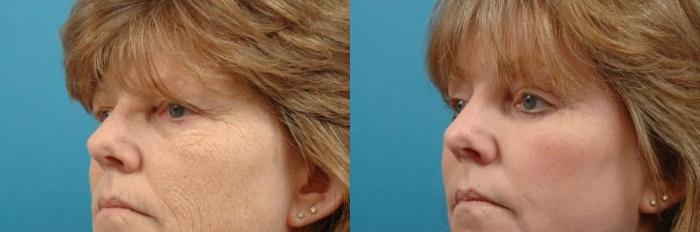 Before & After Brow Lift Case 9 View #2 View in West Des Moines & Ames, IA