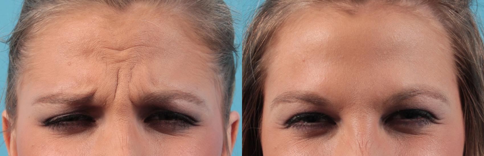 Before & After BOTOX® Cosmetic Case 37 View #1 View in West Des Moines & Ames, IA