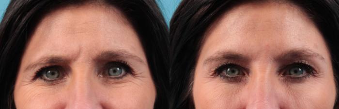 Before & After BOTOX® Cosmetic Case 40 View #1 View in West Des Moines & Ames, IA