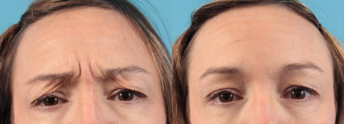 Before & After BOTOX® Cosmetic Case 44 View #1 View in West Des Moines & Ames, IA