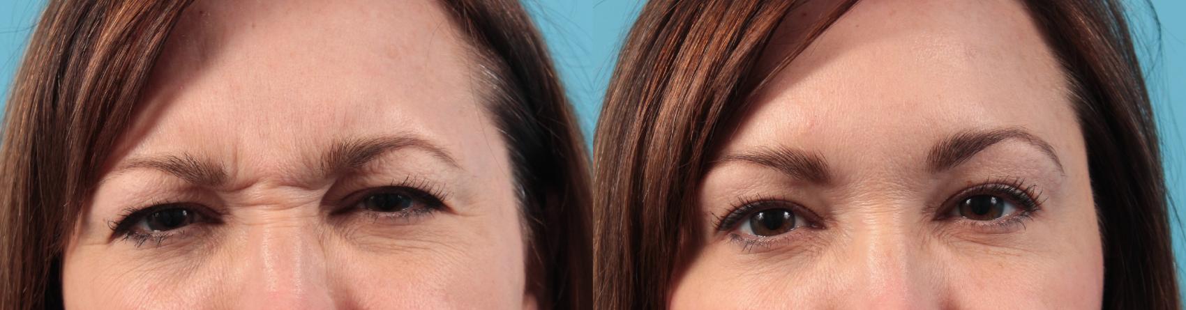Before & After BOTOX® Cosmetic Case 49 View #1 View in West Des Moines & Ames, IA