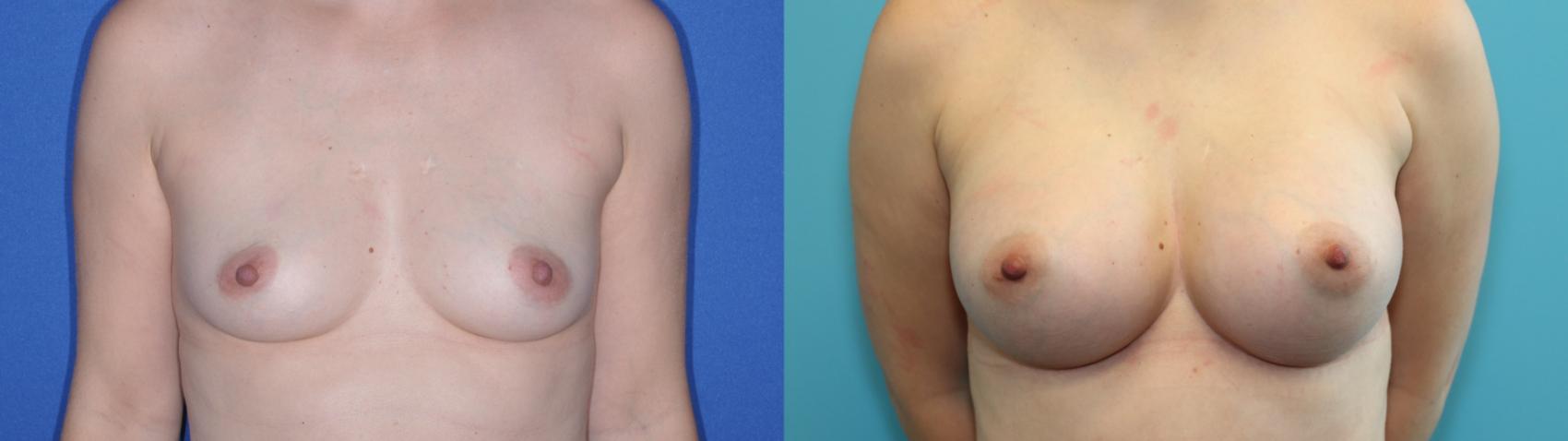 Before & After Breast Augmentation Case 200 Front View in West Des Moines & Ames, IA