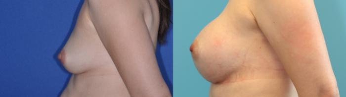 Before & After Breast Augmentation Case 200 Left Side View in West Des Moines & Ames, IA