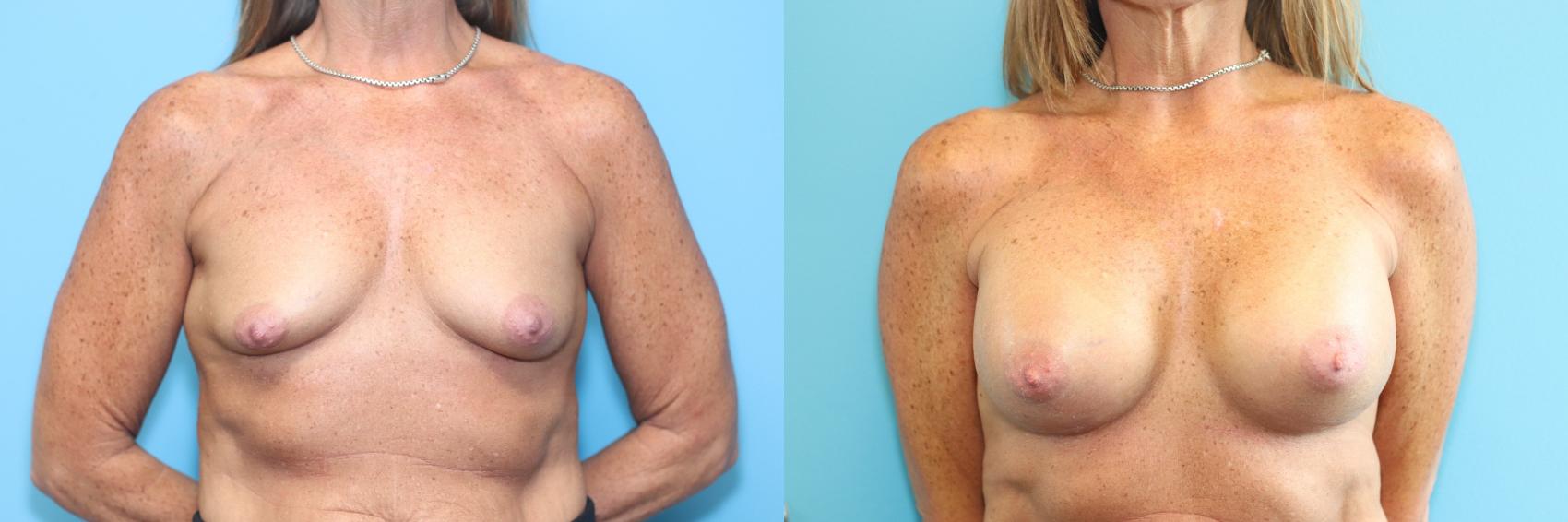 Before & After Breast Augmentation Case 216 Front View in West Des Moines, IA