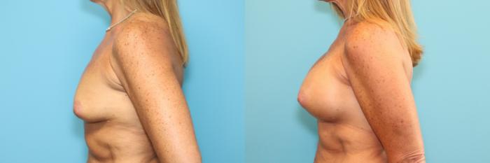 Before & After Breast Augmentation Case 216 Left Side View in West Des Moines & Ames, IA