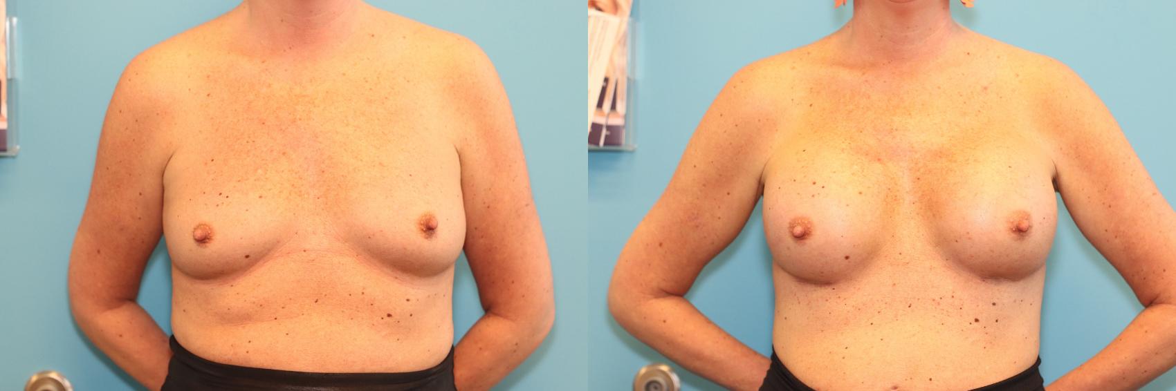 Before & After Breast Augmentation Case 239 Front View in West Des Moines, IA