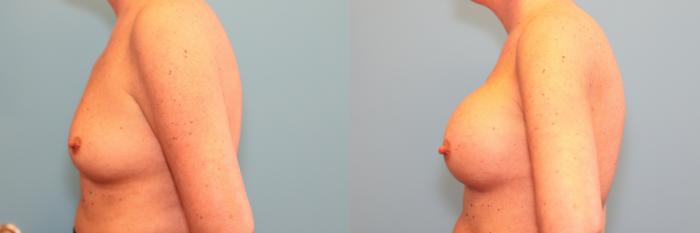 Before & After Breast Augmentation Case 239 Left Side View in West Des Moines & Ames, IA