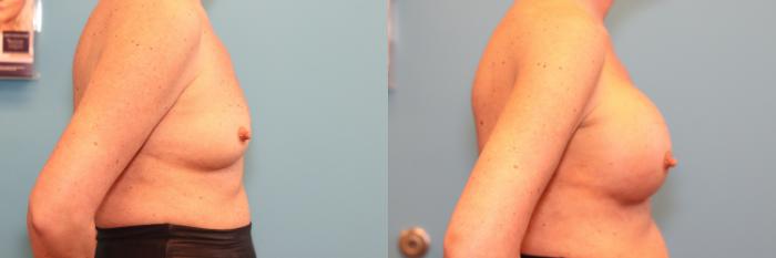 Before & After Breast Augmentation Case 239 Right Side View in West Des Moines & Ames, IA