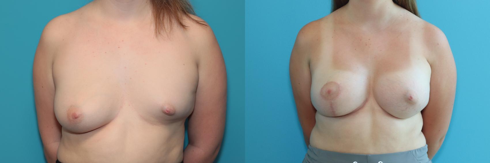 Before & After Breast Lift Case 244 Front View in West Des Moines & Ames, IA