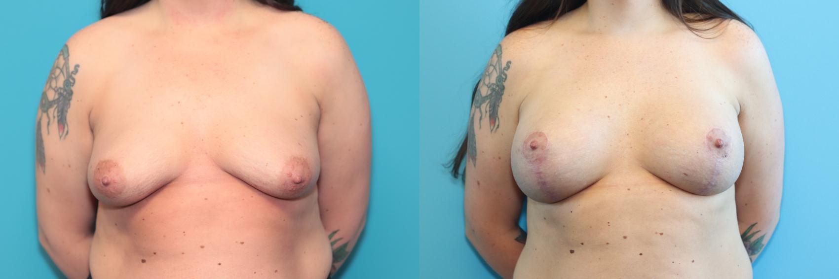 Before & After Breast Augmentation Case 245 Front View in West Des Moines, IA