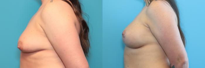 Before & After Breast Lift Case 245 Left Side View in West Des Moines & Ames, IA