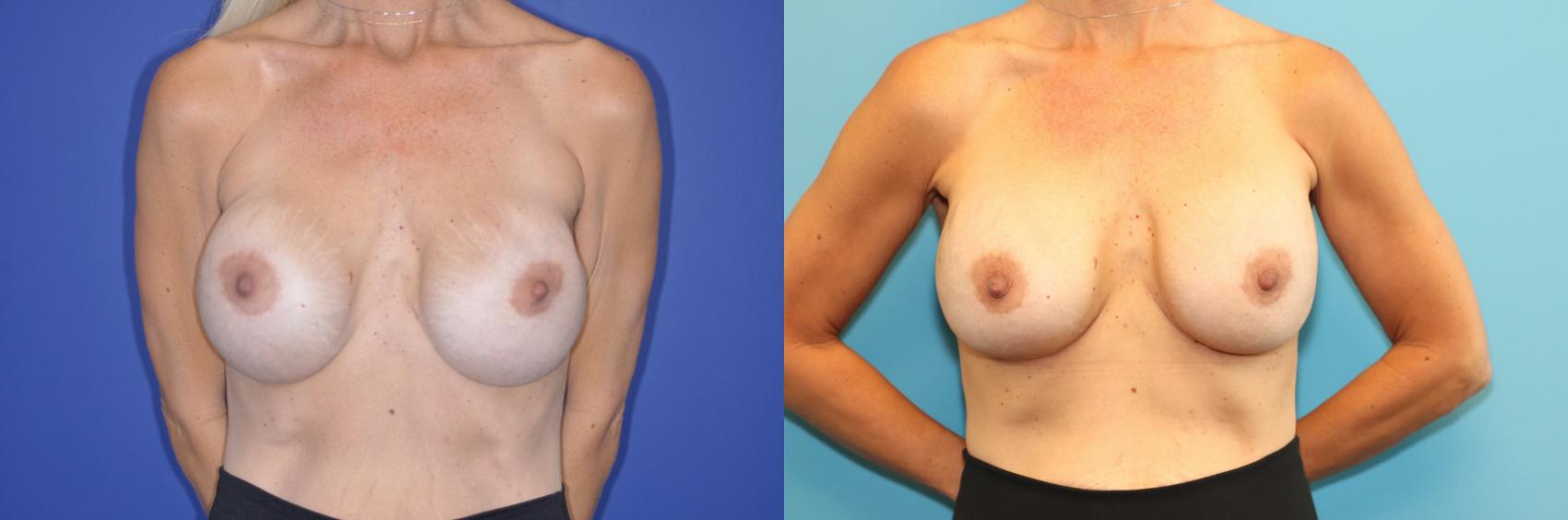 Before & After Breast Augmentation Case 267 Front View in West Des Moines & Ames, IA