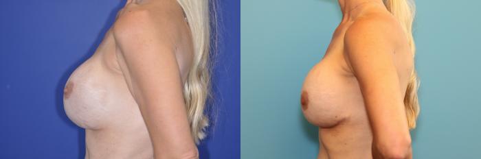 Before & After Breast Augmentation Case 267 Left Side View in West Des Moines & Ames, IA
