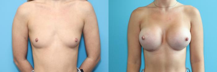 Before & After Breast Augmentation Case 269 Front View in West Des Moines, IA