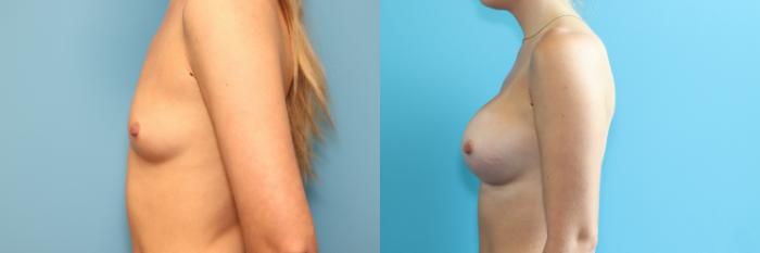 Before & After Breast Augmentation Case 269 Left Side View in West Des Moines & Ames, IA