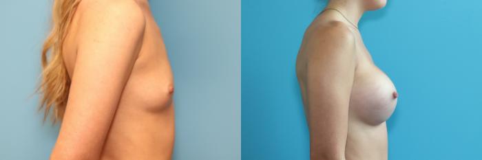 Before & After Breast Augmentation Case 269 Right Side View in West Des Moines & Ames, IA