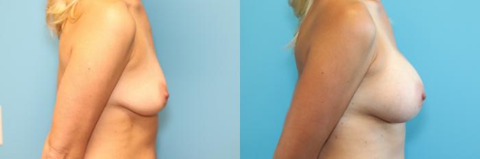 Before & After Breast Augmentation Case 270 Right Side View in West Des Moines & Ames, IA