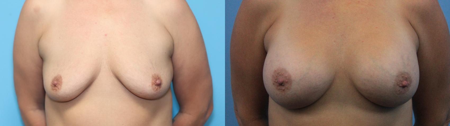 Before & After Breast Augmentation Case 274 Front View in West Des Moines & Ames, IA