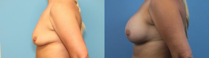 Before & After Breast Augmentation Case 274 Left Side View in West Des Moines & Ames, IA