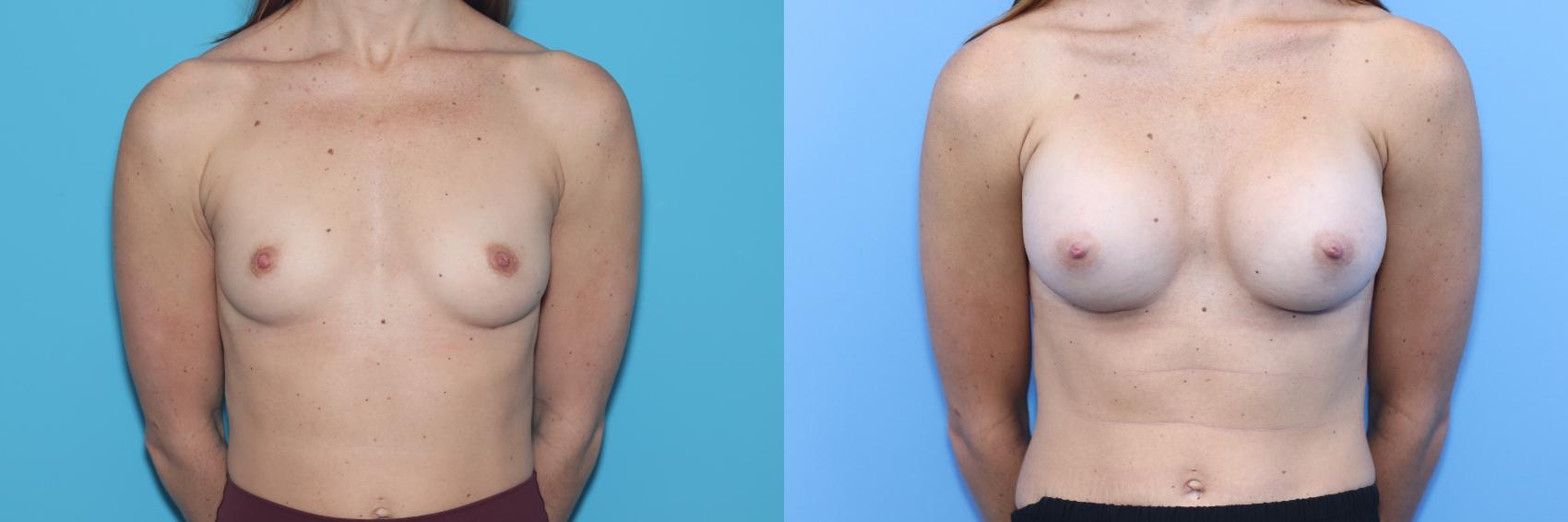 Before & After Breast Augmentation Case 276 Front View in West Des Moines & Ames, IA