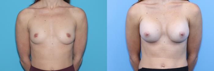 Before & After Breast Augmentation Case 276 Front View in West Des Moines, IA