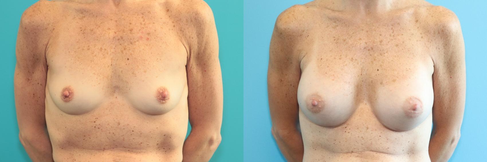 Before & After Breast Augmentation Case 277 Front View in West Des Moines & Ames, IA