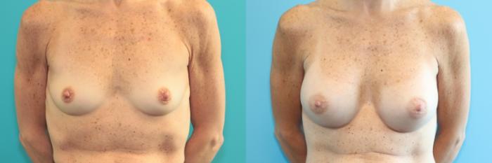 Before & After Breast Augmentation Case 277 Front View in West Des Moines, IA