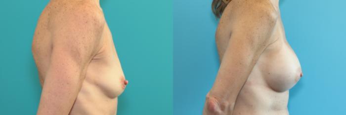 Before & After Breast Augmentation Case 277 Right Side View in West Des Moines & Ames, IA